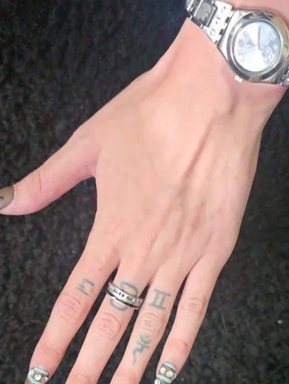 After: the same back of hand after laser tattoo removal