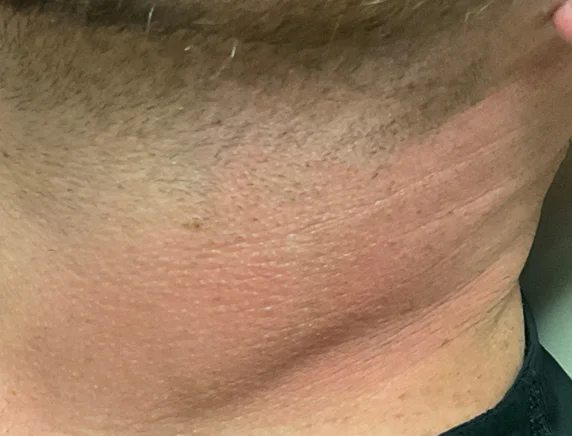 After: the same neck after laser tattoo removal