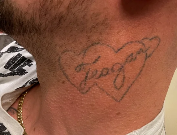 Before: heart and name tattoo on the side of the neck