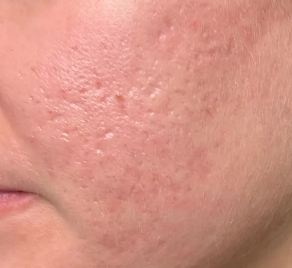 Before: acne scarring and uneven texture on the cheek