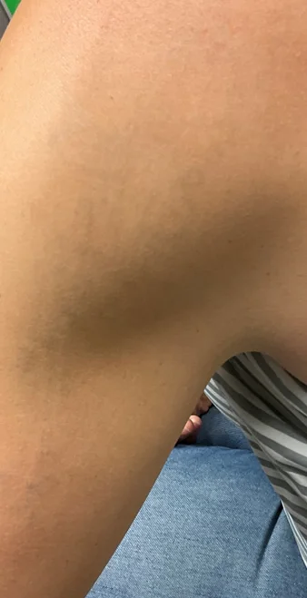 After: the same upper arm after laser tattoo removal